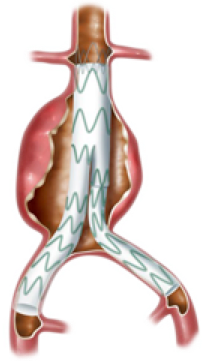 vizag vascular treatment