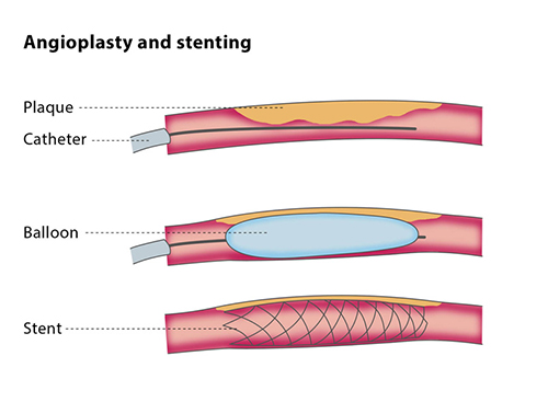 angioplasty and stenting